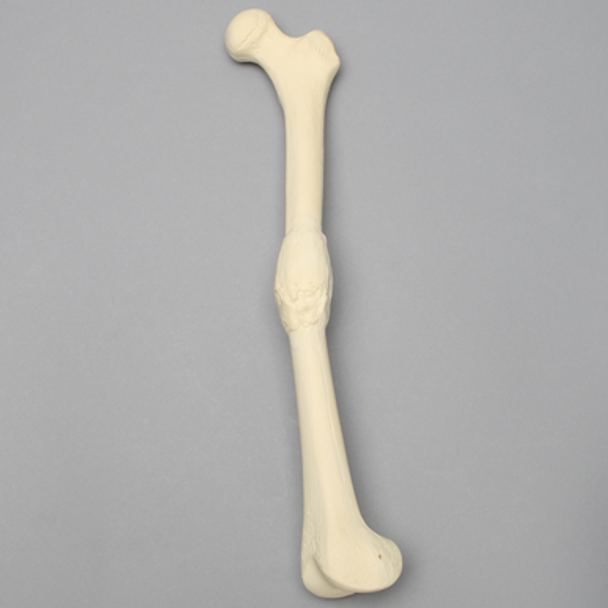 Femur with Midshaft Malunion and Anteversion