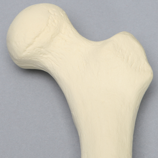 Femur with Midshaft Malunion and Anteversion