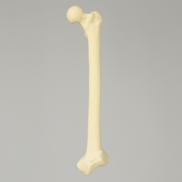 Femur with 20 Degree Distal Valgus Deformity