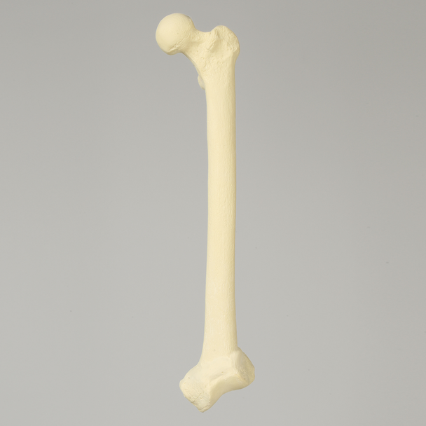 Femur with 20 Degree Distal Valgus Deformity