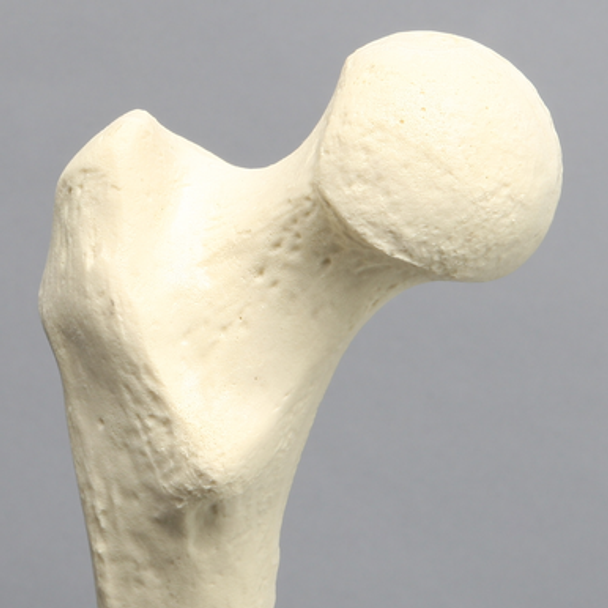 Femur with Hypoplastic Condyle Defect