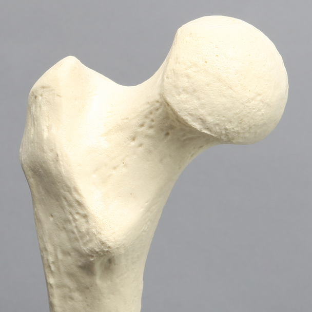 Femur with Hypoplastic Condyle Defect