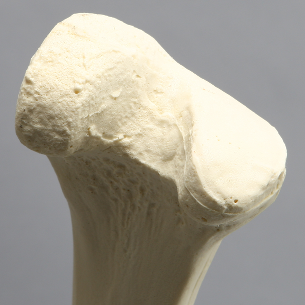 Femur with Hypoplastic Condyle Defect