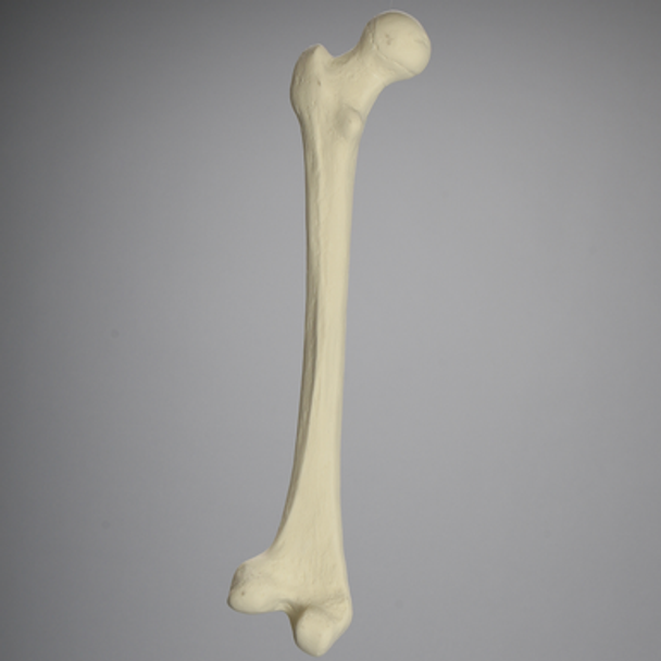 Femur with Distal Valgus Deformity and Rotation