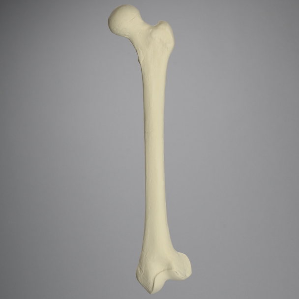 Femur with Distal Valgus Deformity and Rotation