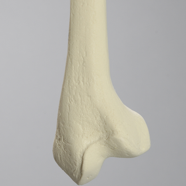 Femur with 25 Degree Distal Valgus Deformity