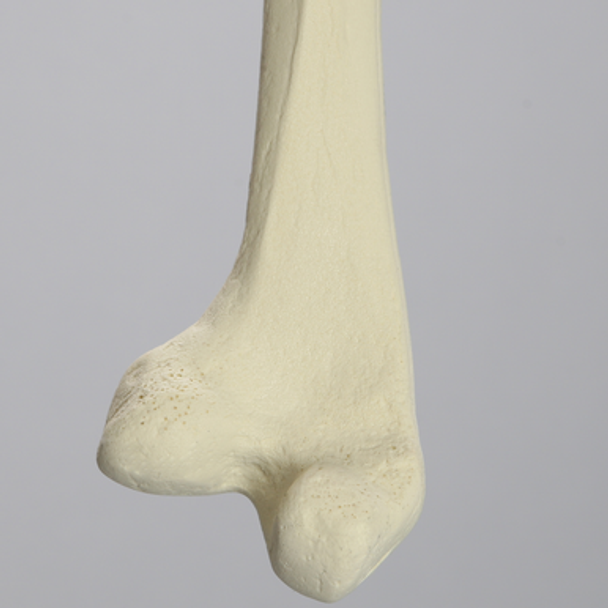 Femur with 25 Degree Distal Valgus Deformity