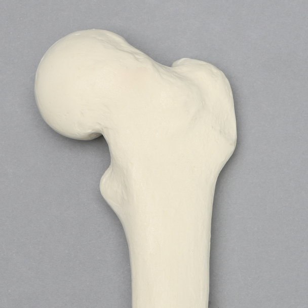 Femur with Slipped Capital Epiphysis
