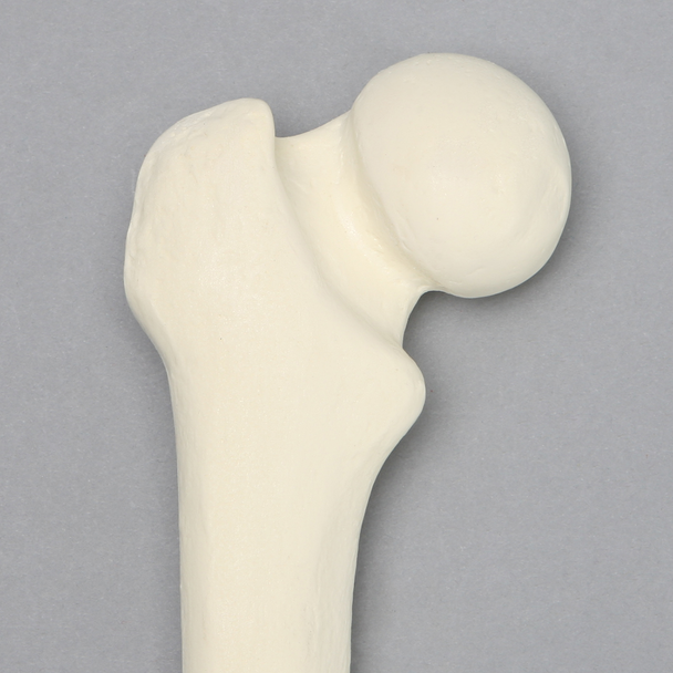 Femur with Slipped Capital Epiphysis