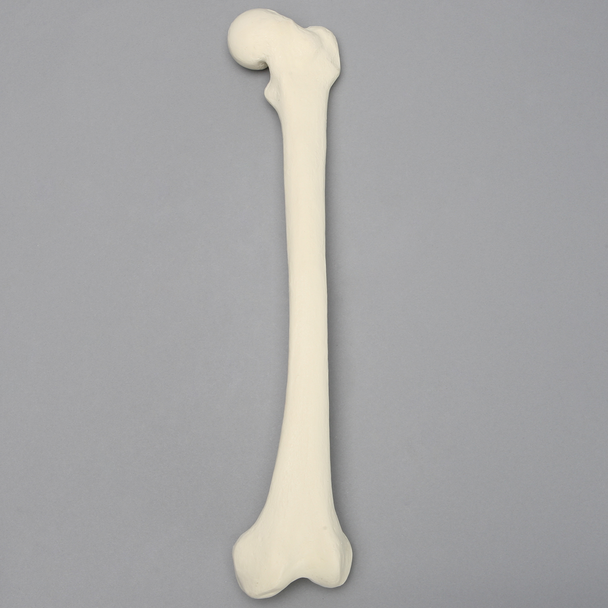 Femur with Slipped Capital Epiphysis