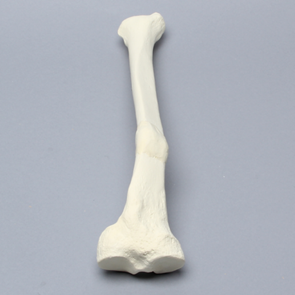 Tibia with Malunion and 25 Degree Valgus Defect
