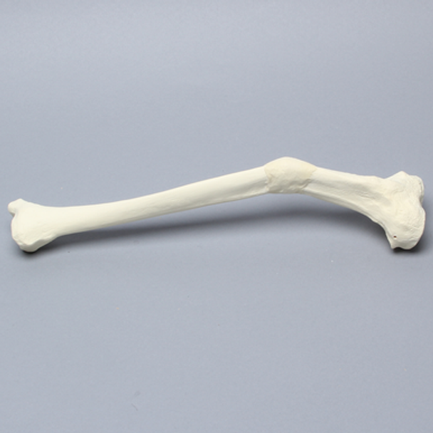 Tibia with Malunion and 25 Degree Valgus Defect