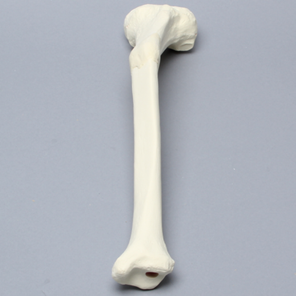 Tibia with Malunion and 25 Degree Valgus Defect