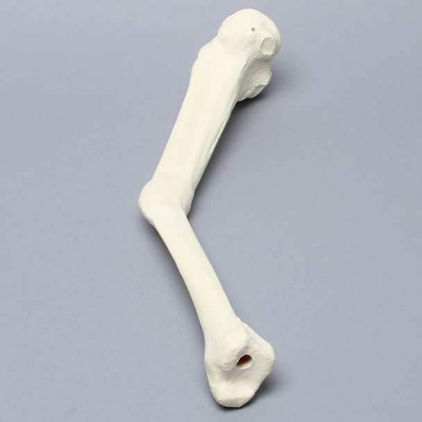 Tibia with Malunion and 20 Degree Procurvatum