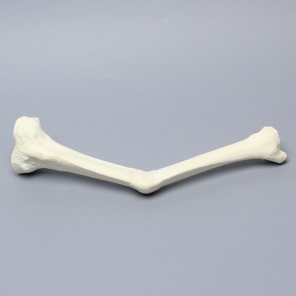 Tibia with Malunion and 20 Degree Procurvatum