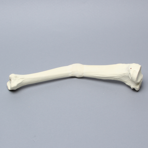 Tibia with Malunion and 20 Degree Procurvatum