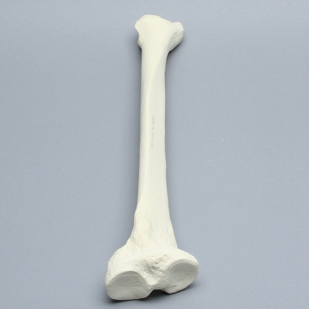 Tibia with Varus and Internal Rotation