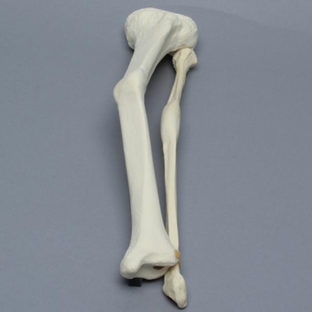 Tibia and Fibula with Malunions, Varus, and Procurvatum