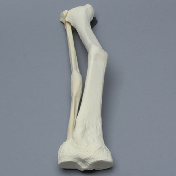 Tibia and Fibula with Malunions, Varus, and Procurvatum