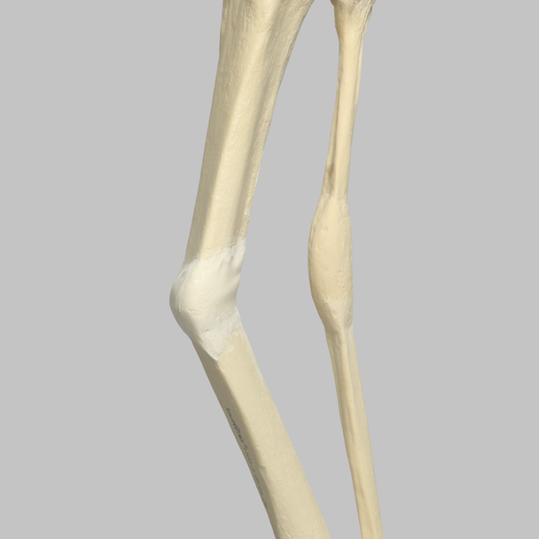 Tibia and Fibula with Malunions, Varus, and Procurvatum