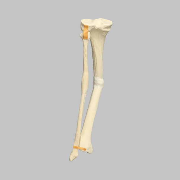 Tibia and Fibula with Malunions, Varus, and Procurvatum