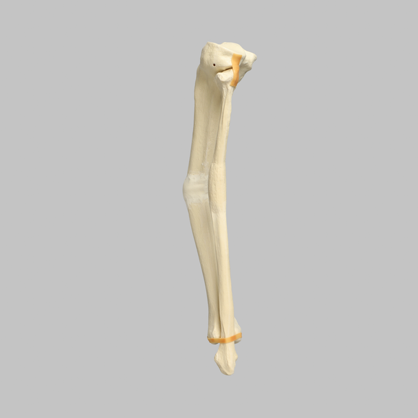 Tibia and Fibula with Malunions, Varus, and Procurvatum
