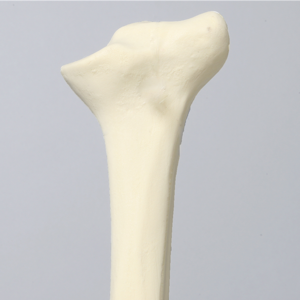 Tibia with Blount's Disease and Varus Deformities, Solid Foam