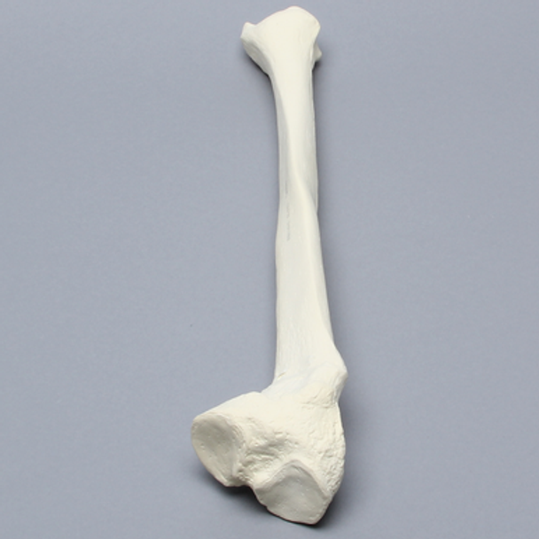 Tibia with Midshaft Malunion and Blount's Disease