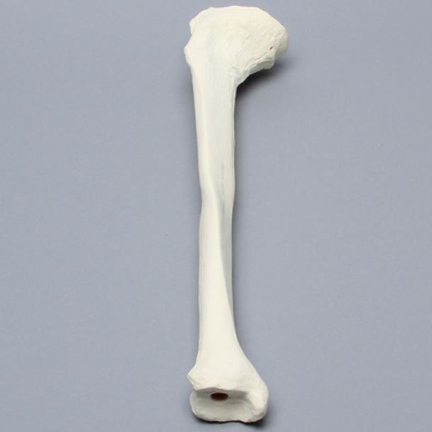 Tibia with Midshaft Malunion and Blount's Disease