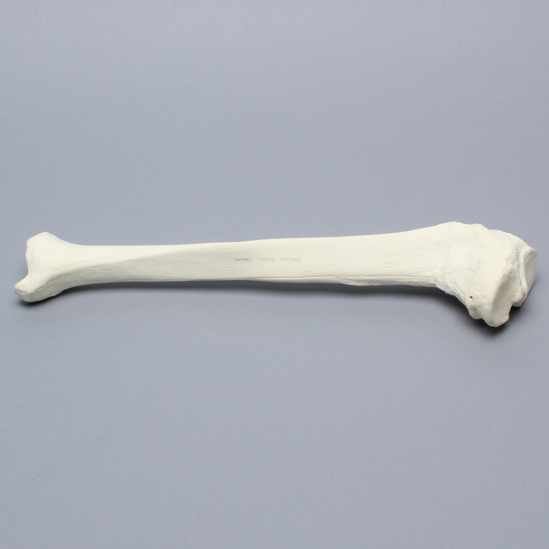 Tibia with Midshaft Malunion and Blount's Disease