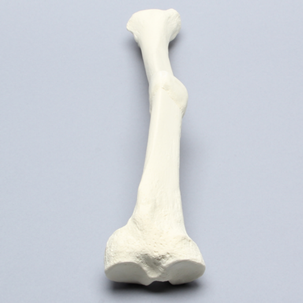 Tibia with Malunion and 17 Degree Plane Defect
