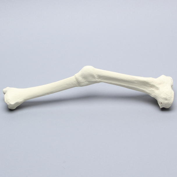 Tibia with Malunion and 17 Degree Plane Defect