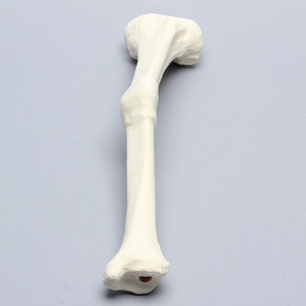 Tibia with Malunion and 17 Degree Plane Defect