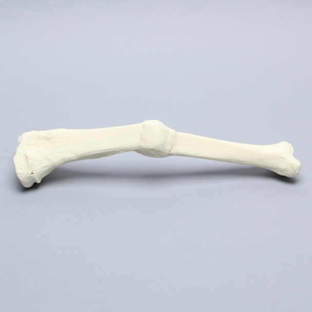 Tibia with Malunion and 17 Degree Plane Defect
