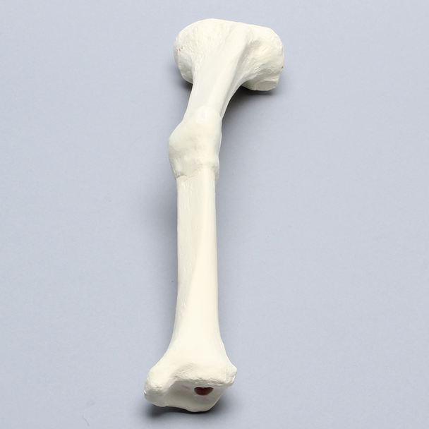 Tibia with Malunion and 17 Degree Plane Defect