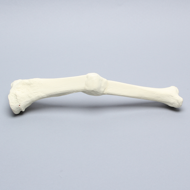 Tibia with Malunion and 17 Degree Plane Defect