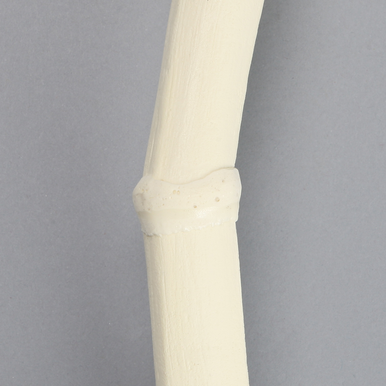 Tibia with Double Level Angulation
