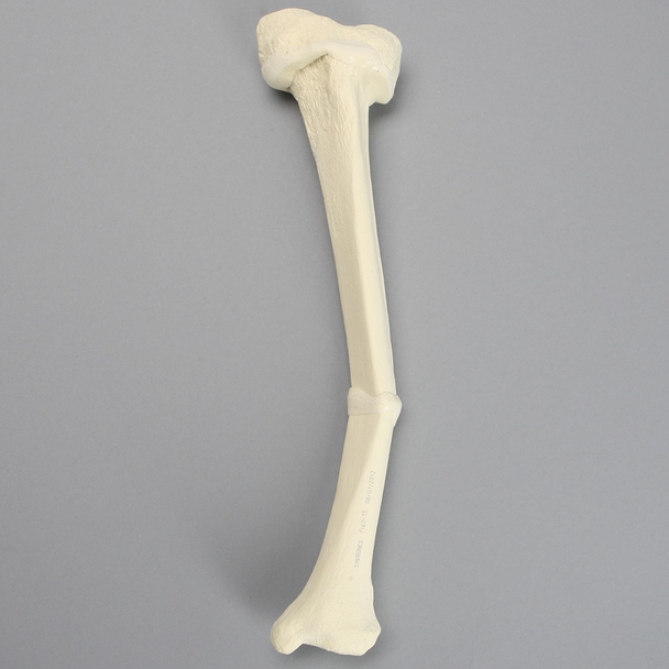 Tibia with Double Level Angulation