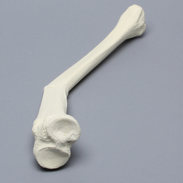 Tibia with Malunion and 25 Degree Procurvatum