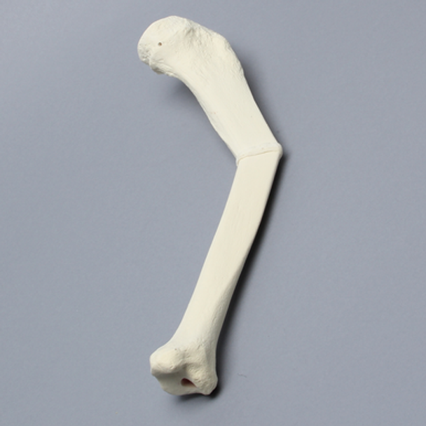 Tibia with Malunion and 25 Degree Procurvatum