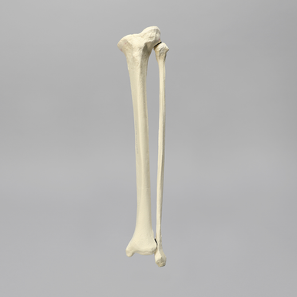 Tibia and Fibula with Varus Defect, Solid Foam