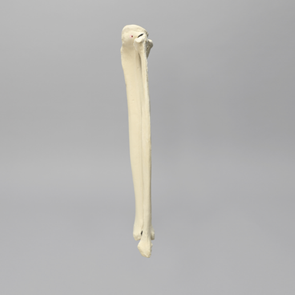 Tibia and Fibula with Varus Defect, Solid Foam
