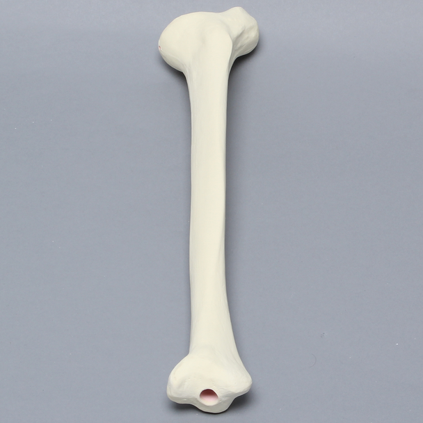 Tibia with 30 Degrees Varus Defect