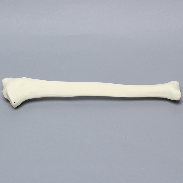 Tibia with 30 Degrees Varus Defect