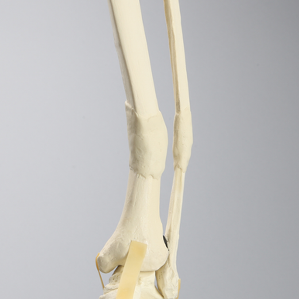 Foot and Ankle with Distal Malunion and Rotation