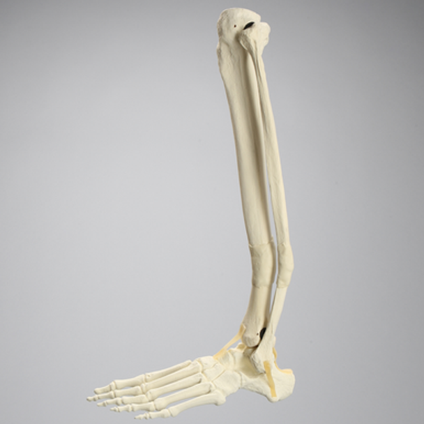 Foot and Ankle with Distal Malunion and Rotation