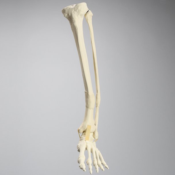 Foot and Ankle with Distal Malunion and Rotation