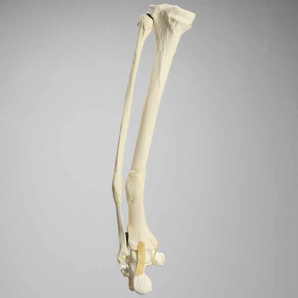 Foot and Ankle with Distal Malunion and Rotation
