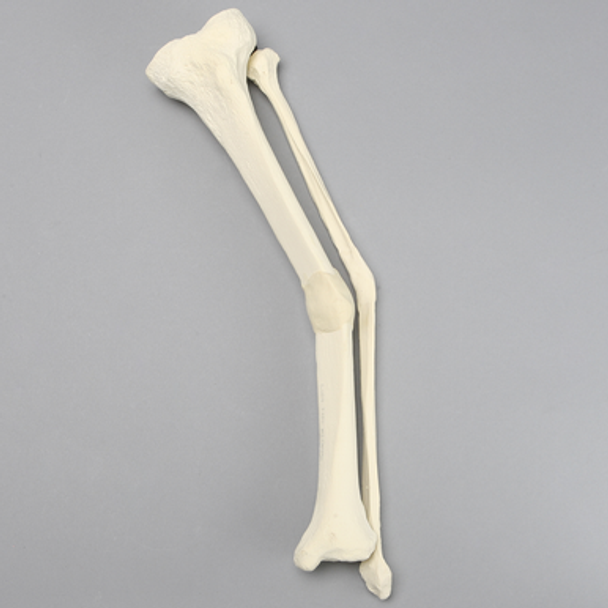 Tibia and Fibula with Malunions and 25º Varus Defect