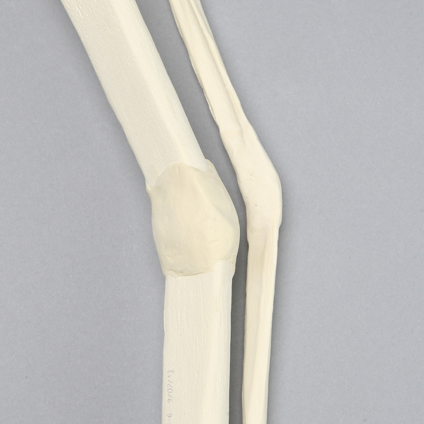 Tibia and Fibula with Malunions and 25º Varus Defect